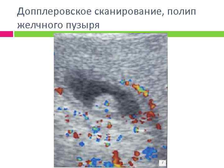 Допплеровское сканирование, полип желчного пузыря 