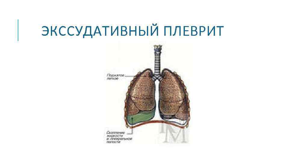  ЭКССУДАТИВНЫЙ ПЛЕВРИТ 