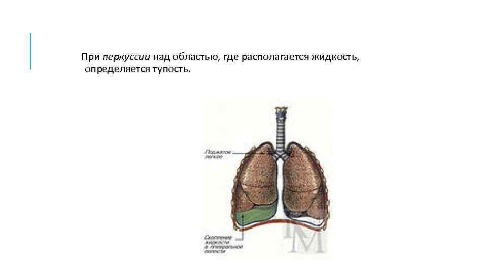 При перкуссии над областью, где располагается жидкость, определяется тупость. 