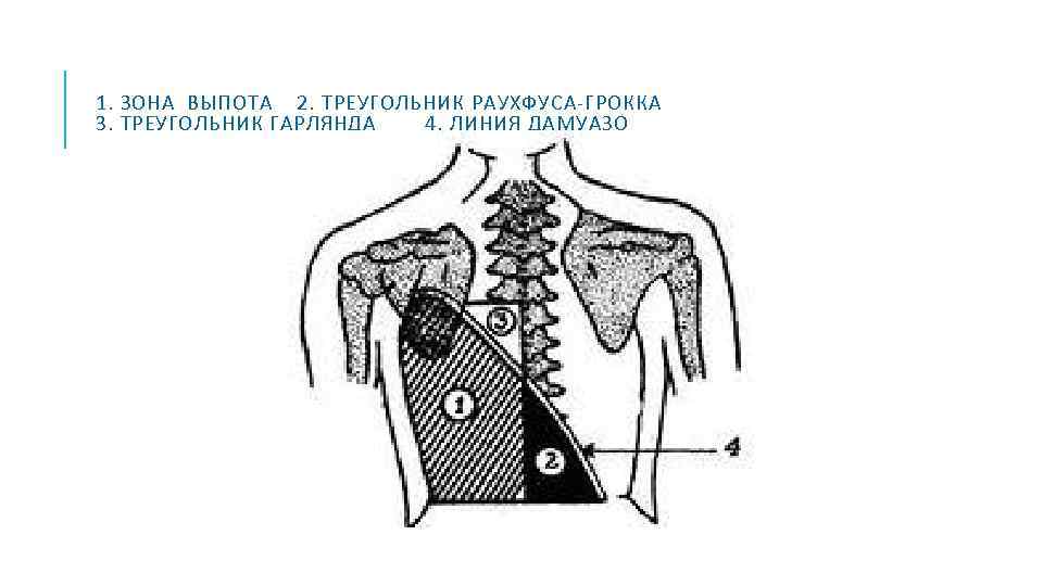 1. ЗОНА ВЫПОТА 2. ТРЕУГОЛЬНИК РАУХФУСА ГРОККА 3. ТРЕУГОЛЬНИК ГАРЛЯНДА 4. ЛИНИЯ ДАМУАЗО 