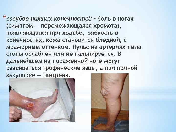 *сосудов нижних конечностей - боль в ногах (симптом — перемежающаяся хромота), появляющаяся при ходьбе,