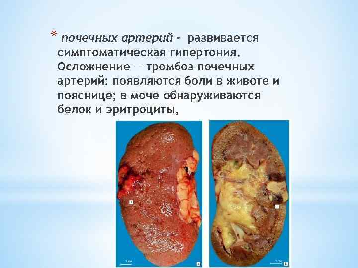 * почечных артерий - развивается симптоматическая гипертония. Осложнение — тромбоз почечных артерий: появляются боли