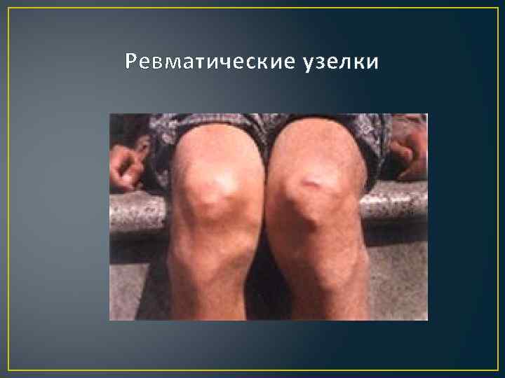 Ревматические узелки 