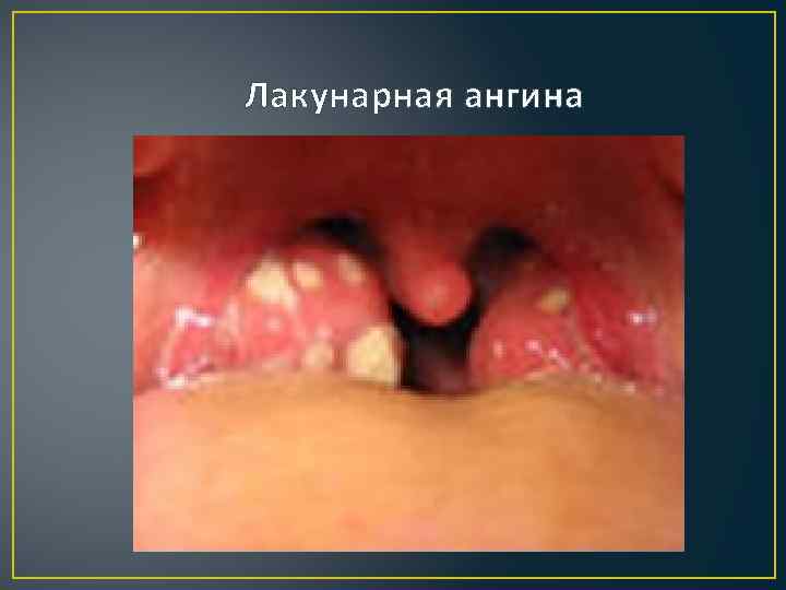 Лакунарная ангина 