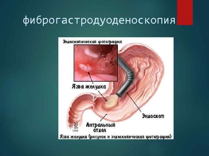 фиброгастродуоденоскопия 