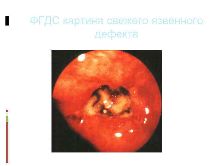 ФГДС картина свежего язвенного дефекта 