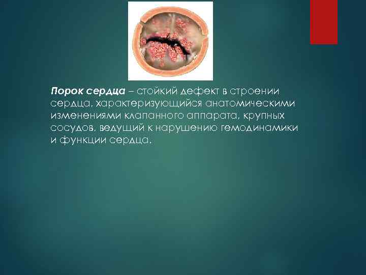 Порок сердца – стойкий дефект в строении сердца, характеризующийся анатомическими изменениями клапанного аппарата, крупных