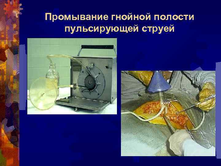 Промывание гнойной полости пульсирующей струей 