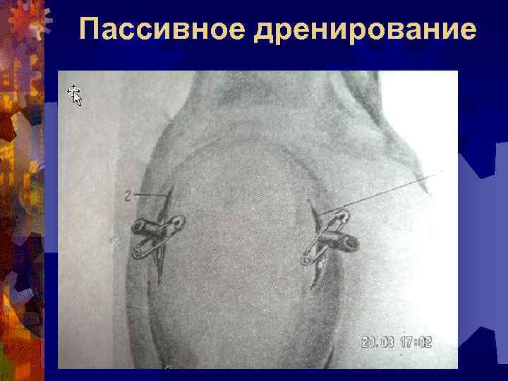 Пассивное дренирование 