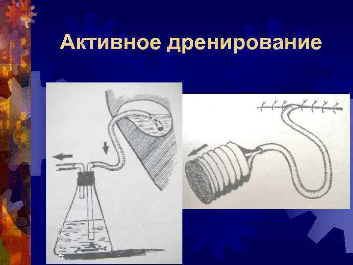 Активное дренирование 
