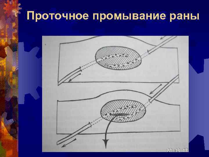 Проточное промывание раны 