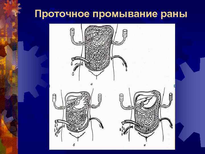 Проточное промывание раны 