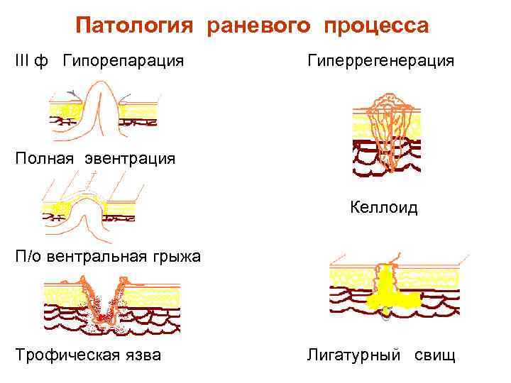 Патология раневого процесса III ф Гипорепарация Гиперрегенерация Полная эвентрация Келлоид П/о вентральная грыжа Трофическая