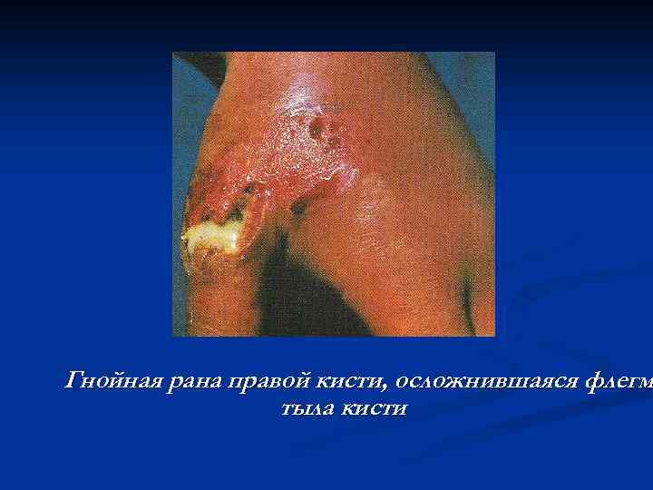Гнойная рана правой кисти, осложнившаяся флегм тыла кисти 