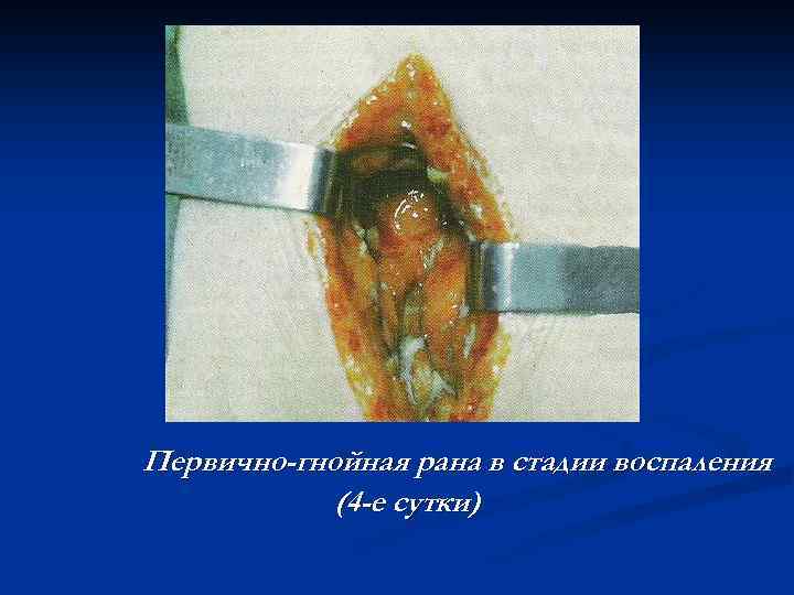 Первично-гнойная рана в стадии воспаления (4 -е сутки) 