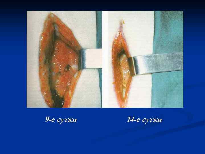 9 -е сутки 14 -е сутки 