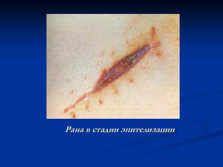 Рана в стадии эпителизации 