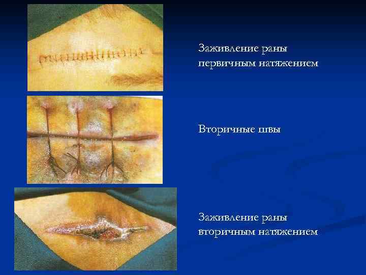 Заживление раны первичным натяжением Вторичные швы Заживление раны вторичным натяжением 