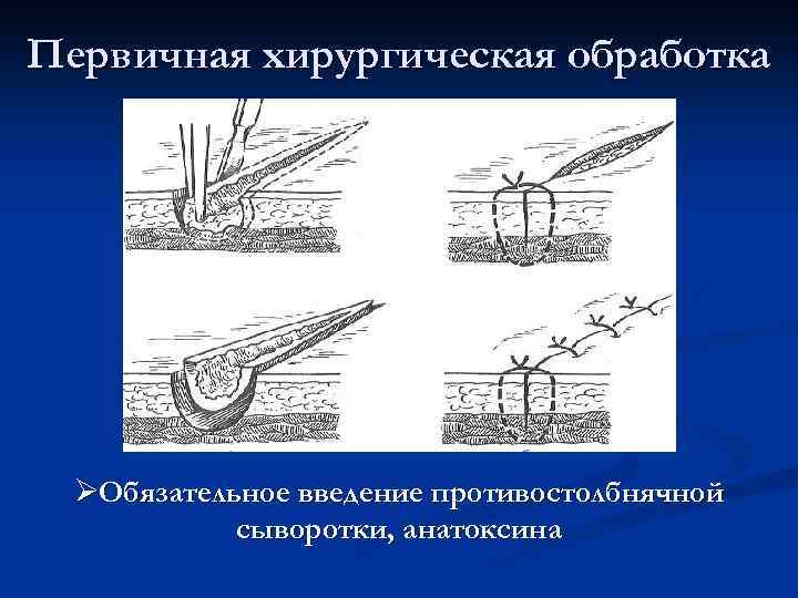 Первичная хирургическая обработка ØОбязательное введение противостолбнячной сыворотки, анатоксина 