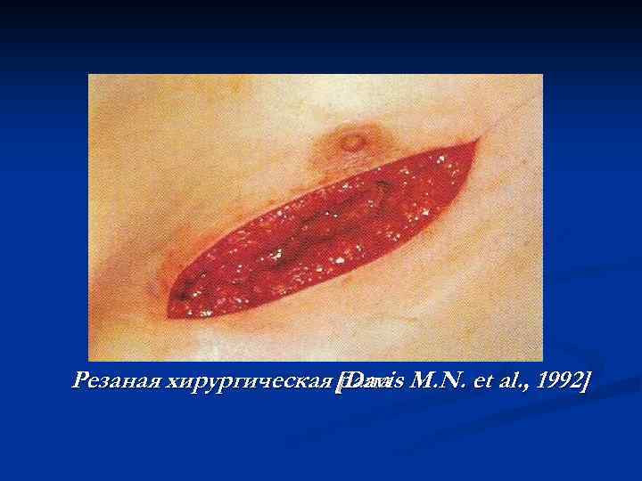 Резаная хирургическая [Davis M. N. et al. , 1992] рана 