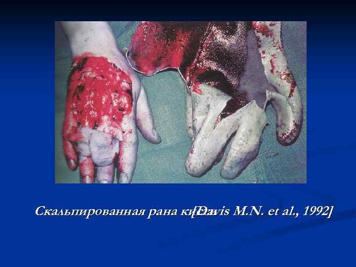Скальпированная рана кисти M. N. et al. , 1992] [Davis 