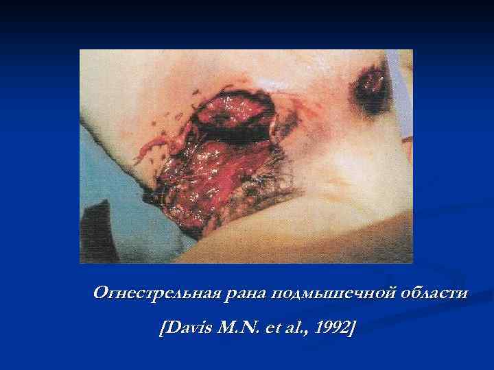 Огнестрельная рана подмышечной области [Davis M. N. et al. , 1992] 