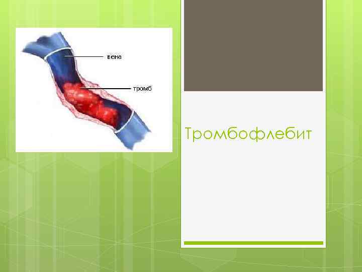 Тромбофлебит 