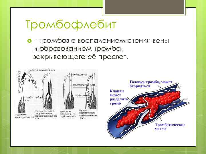 Тромбофлебит - тромбоз с воспалением стенки вены и образованием тромба, закрывающего её просвет. 