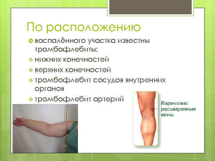 По расположению воспалённого участка известны тромбофлебиты: v нижних конечностей v верхних конечностей v тромбофлебит