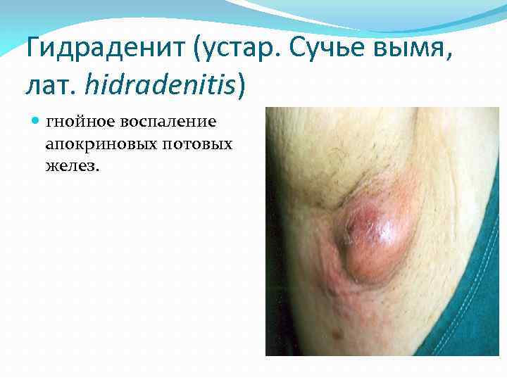 Гидраденит (устар. Сучье вымя, лат. hidradenitis) гнойное воспаление апокриновых потовых желез. 