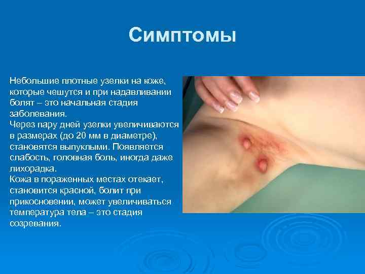 Симптомы Небольшие плотные узелки на коже, которые чешутся и при надавливании болят – это
