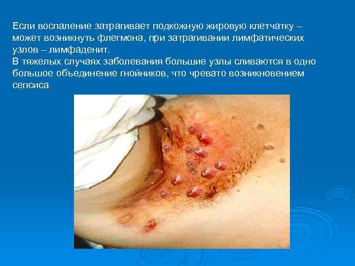 Если воспаление затрагивает подкожную жировую клетчатку – может возникнуть флегмона, при затрагивании лимфатических узлов