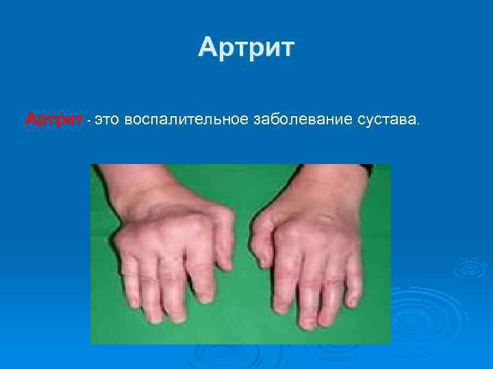 Артрит - это воспалительное заболевание сустава. 
