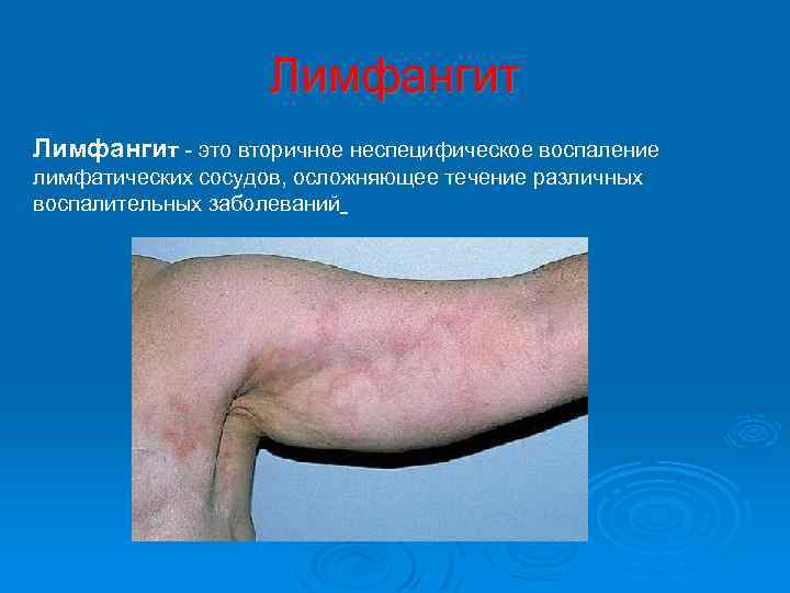 Лимфангит - это вторичное неспецифическое воспаление лимфатических сосудов, осложняющее течение различных воспалительных заболеваний 