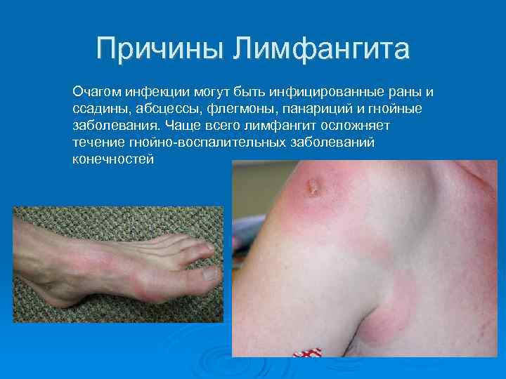 Причины Лимфангита Очагом инфекции могут быть инфицированные раны и ссадины, абсцессы, флегмоны, панариций и