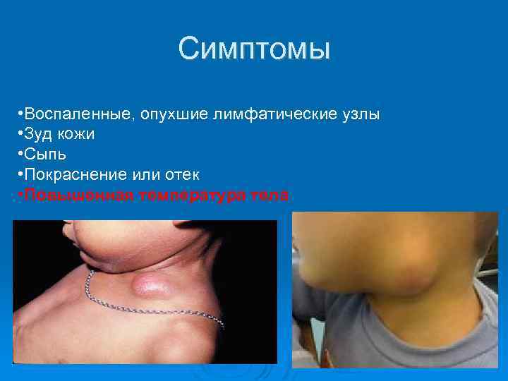 Симптомы • Воспаленные, опухшие лимфатические узлы • Зуд кожи • Сыпь • Покраснение или