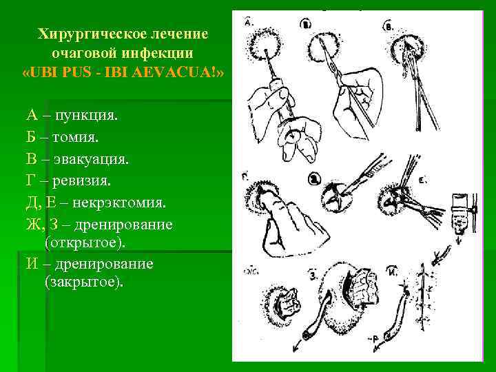 Хирургическое лечение очаговой инфекции «UBI PUS - IBI AEVACUA!» А – пункция. Б –