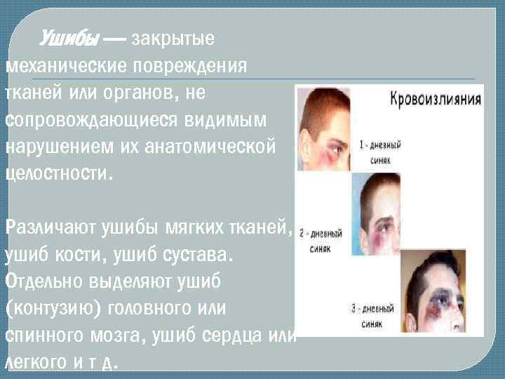 Ушибы — закрытые механические повреждения тканей или органов, не сопровождающиеся видимым нарушением их анатомической