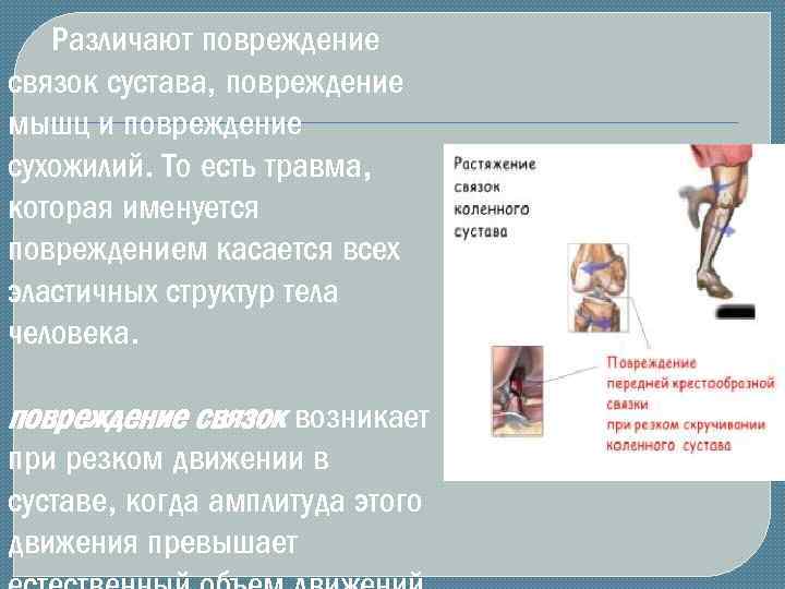 Различают повреждение связок сустава, повреждение мышц и повреждение сухожилий. То есть травма, которая именуется