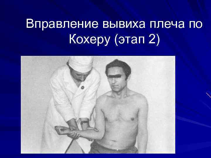 Вправление вывиха плеча по Кохеру (этап 2) 