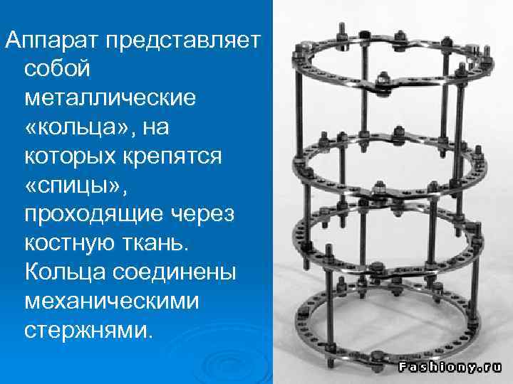 Аппарат представляет собой металлические «кольца» , на которых крепятся «спицы» , проходящие через костную