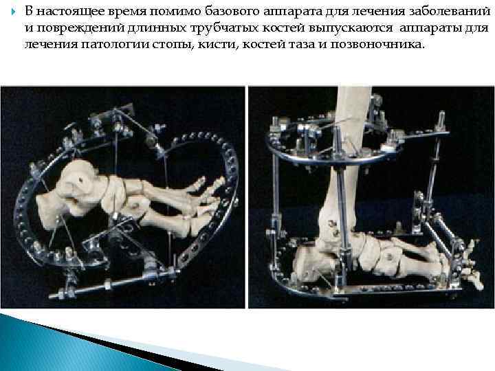  В настоящее время помимо базового аппарата для лечения заболеваний и повреждений длинных трубчатых