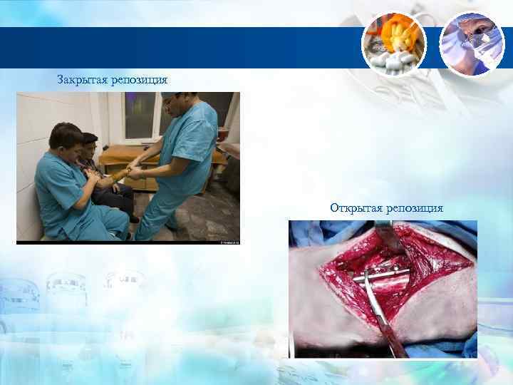 Закрытая репозиция Открытая репозиция 