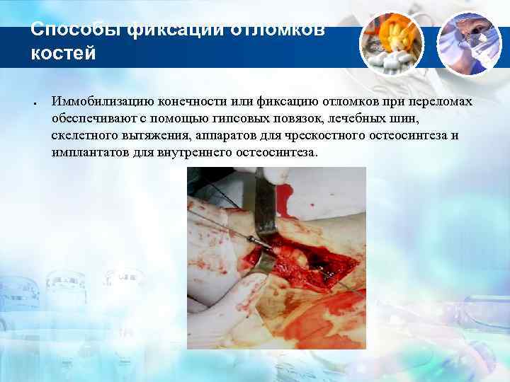 Способы фиксации отломков костей Иммобилизацию конечности или фиксацию отломков при переломах обеспечивают с помощью