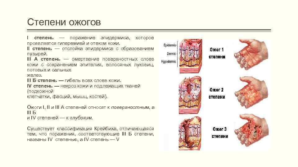 Степени ожогов I степень — поражение эпидермиса, которое проявляется гиперемией и отеком кожи. II