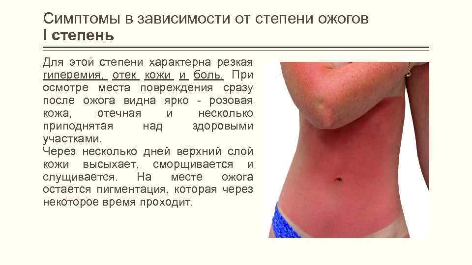 Симптомы в зависимости от степени ожогов I степень Для этой степени характерна резкая гиперемия,