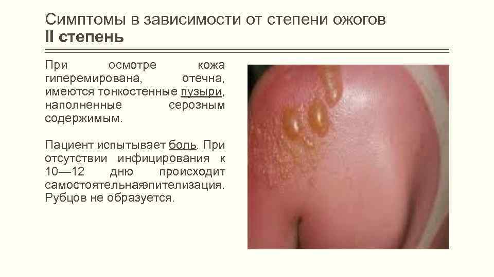 Симптомы в зависимости от степени ожогов II степень При осмотре кожа гиперемирована, отечна, имеются