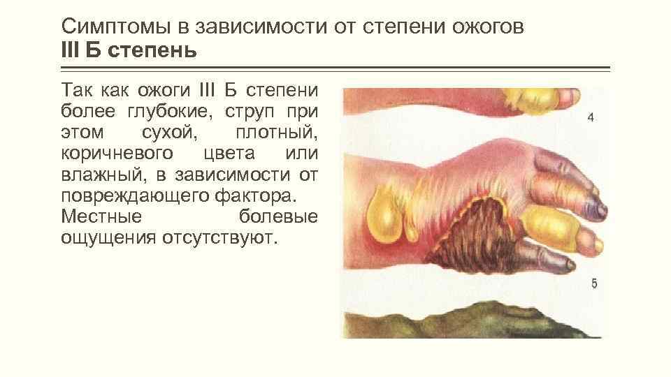 Симптомы в зависимости от степени ожогов III Б степень Так как ожоги III Б