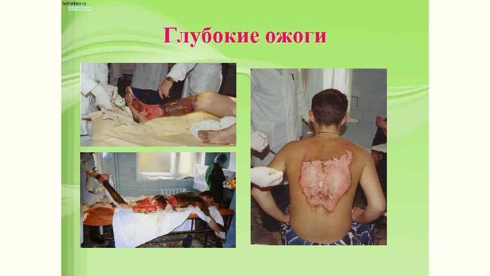 Глубокие ожоги 