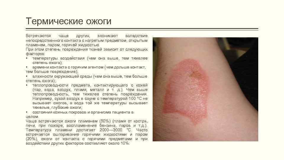 Термические ожоги Встречаются чаще других, возникают вследствие непосредственного контакта с нагретым предметом, открытым пламенем,